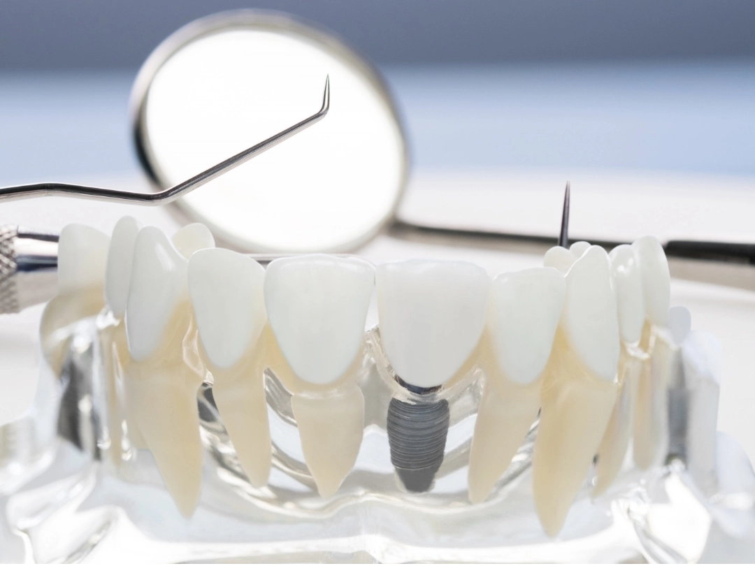 Dental Implants
