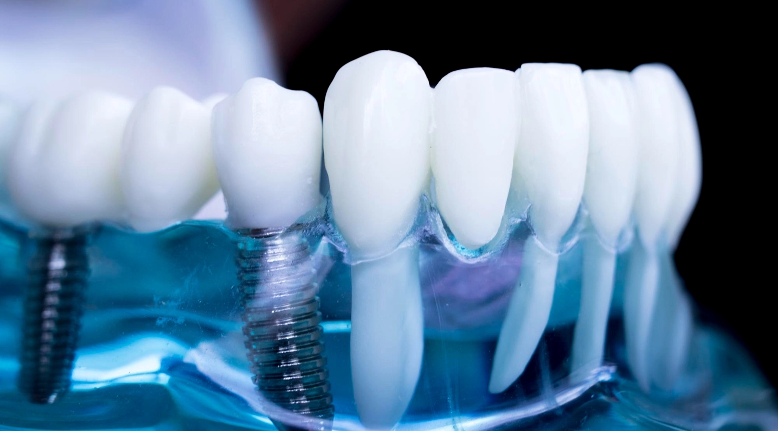 Dental Implants Header